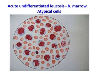 Acute undifferentiated leucosis– b. marrow.
Аtypical cells
 