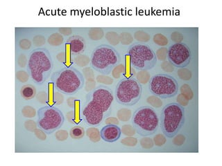 Acute myeloblastic leukemia
 
