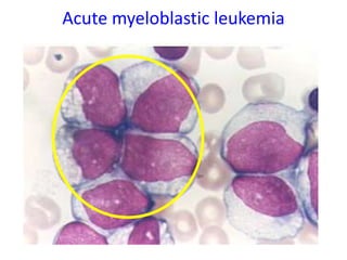 Acute myeloblastic leukemia
 