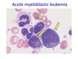 Acute myeloblastic leukemia
 