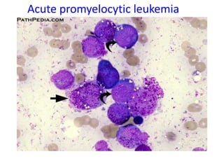 Acute promyelocytic leukemia
 
