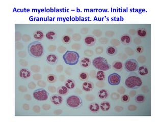 Acute myeloblastic – b. marrow. Initial stage.
Granular myeloblast. Aur’s stab
 