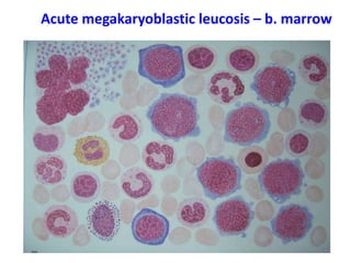 Acute megakaryoblastic leucosis – b. marrow
 