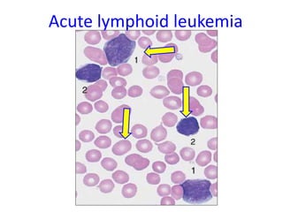 Acute lymphoid leukemia
 