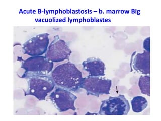 Acute В-lymphoblastosis – b. marrow Big
vacuolized lymphoblastes
 