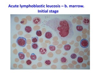 Acute lymphoblastic leucosis – b. marrow.
Initial stage
 