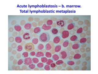 Acute lymphoblastosis – b. marrow.
Тоtal lymphoblastic metaplasia
 