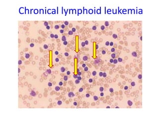 Chronical lymphoid leukemia
 