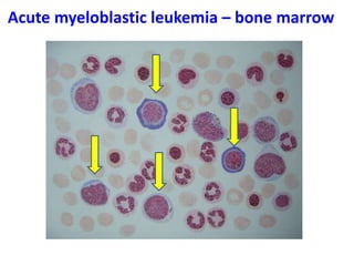 Acute myeloblastic leukemia – bone marrow
 