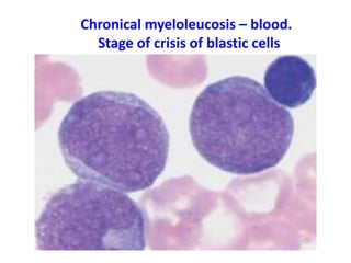 Chronical myeloleucosis – blood.
Stage of crisis of blastic cells
 