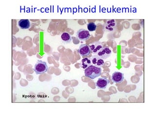 Hair-cell lymphoid leukemia
 