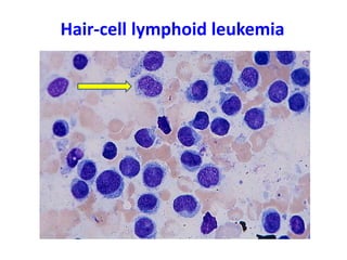 Hair-cell lymphoid leukemia
 