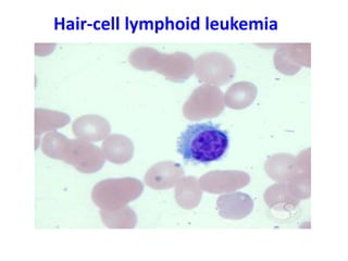 Hair-cell lymphoid leukemia
 