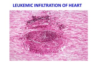 LEUKEMIC INFILTRATION OF HEART
 