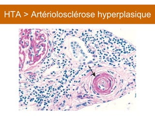 HTA > Artériolosclérose hyperplasique 
