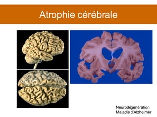 Atrophie cérébrale Neurodégénération Maladie d’Alzheimer 