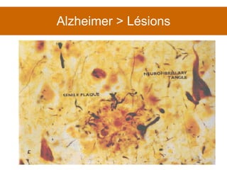 Alzheimer > Lésions 