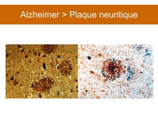 Alzheimer > Plaque neuritique 