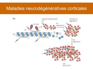 Maladies neurodégénératives corticales 