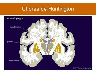 Chorée de Huntington 