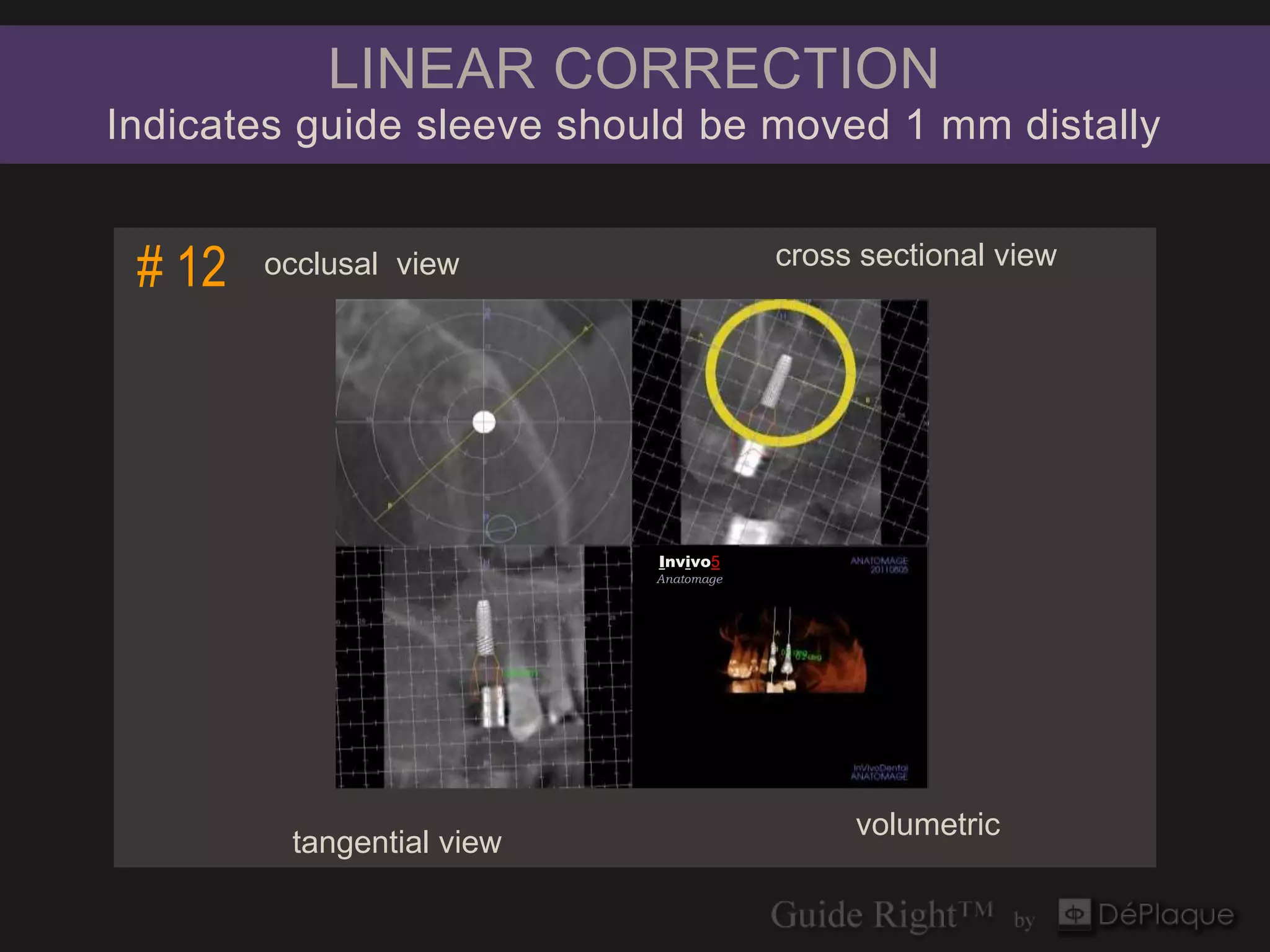 LINEAR CORRECTION
Indicates guide sleeve should be moved 1 mm distally


 # 12   occlusal view                     cross sectional view




                           Invivo5
                           Anatomage
                               Invivo5
                              Anatomage




                                               volumetric
         tangential view
 