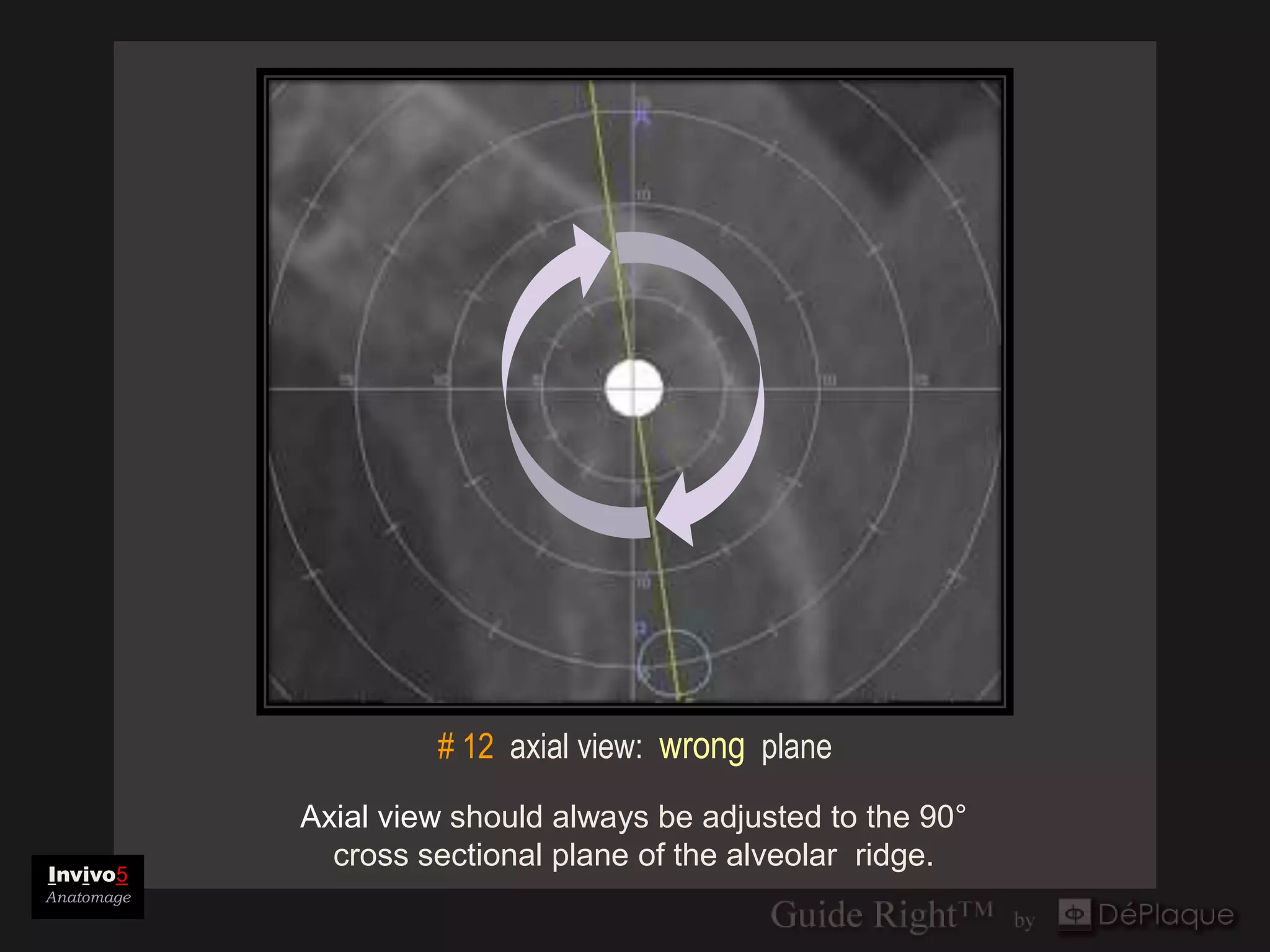# 12 axial view: wrong plane
            Axial view should always be adjusted to the 90°
              cross sectional plane of the alveolar ridge.
Invivo5
Anatomage
 