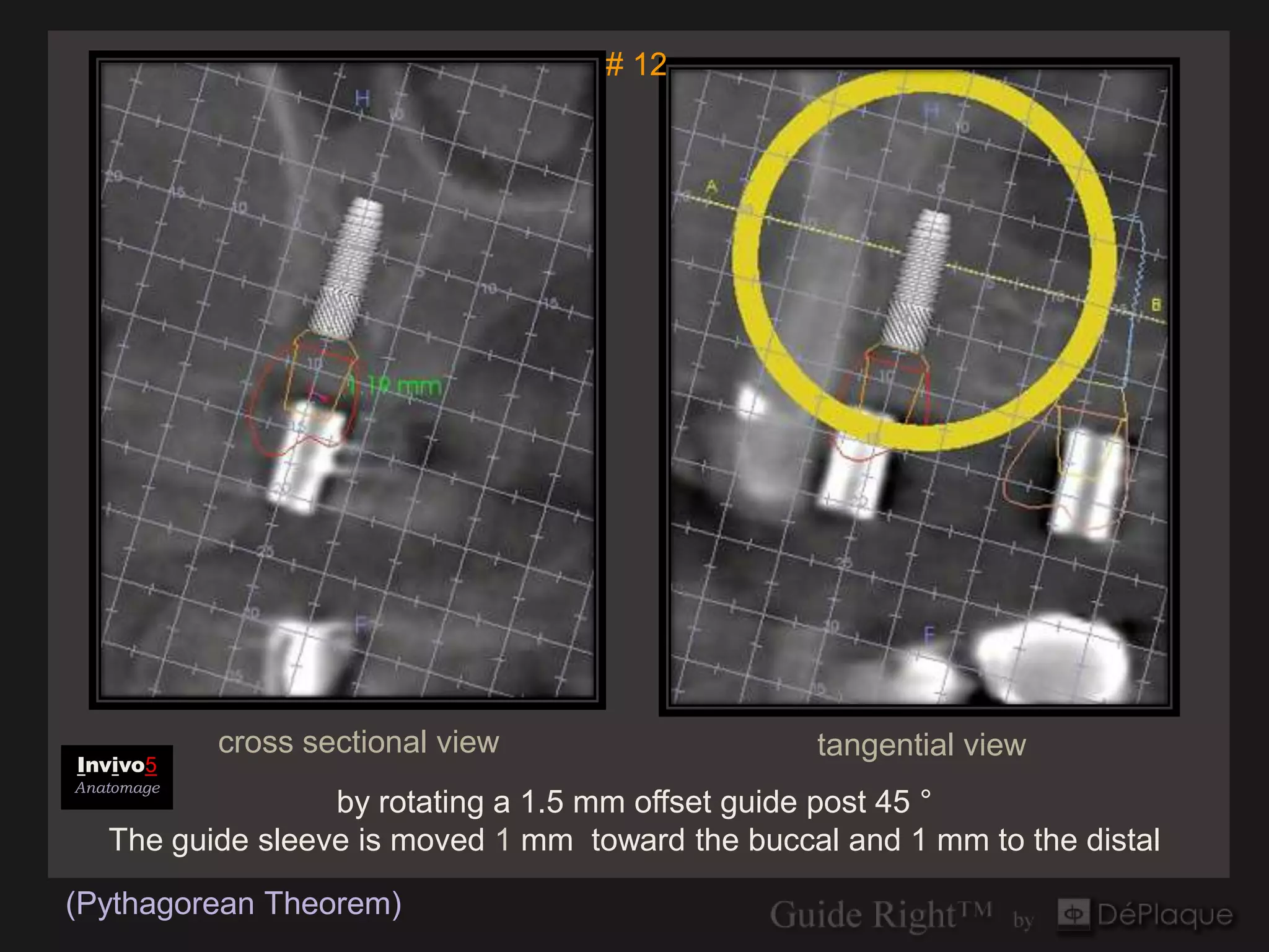 # 12




            cross sectional view                  tangential view
Invivo5
Anatomage
                  by rotating a 1.5 mm offset guide post 45 °
   The guide sleeve is moved 1 mm toward the buccal and 1 mm to the distal

(Pythagorean Theorem)
 