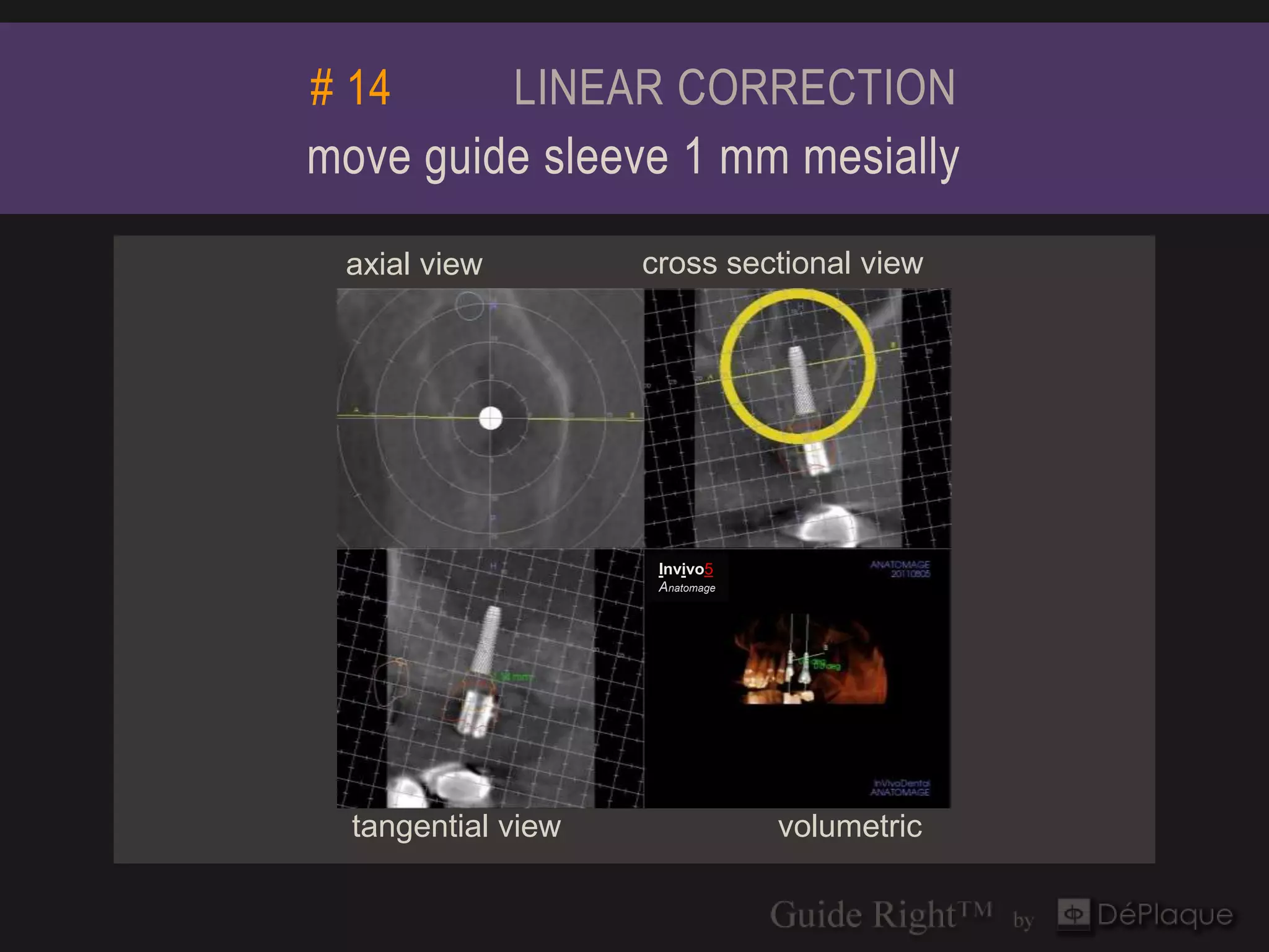 # 14     LINEAR CORRECTION
move guide sleeve 1 mm mesially
 axial view         cross sectional view




                     Invivo5
                     Anatomage




  tangential view                volumetric
 