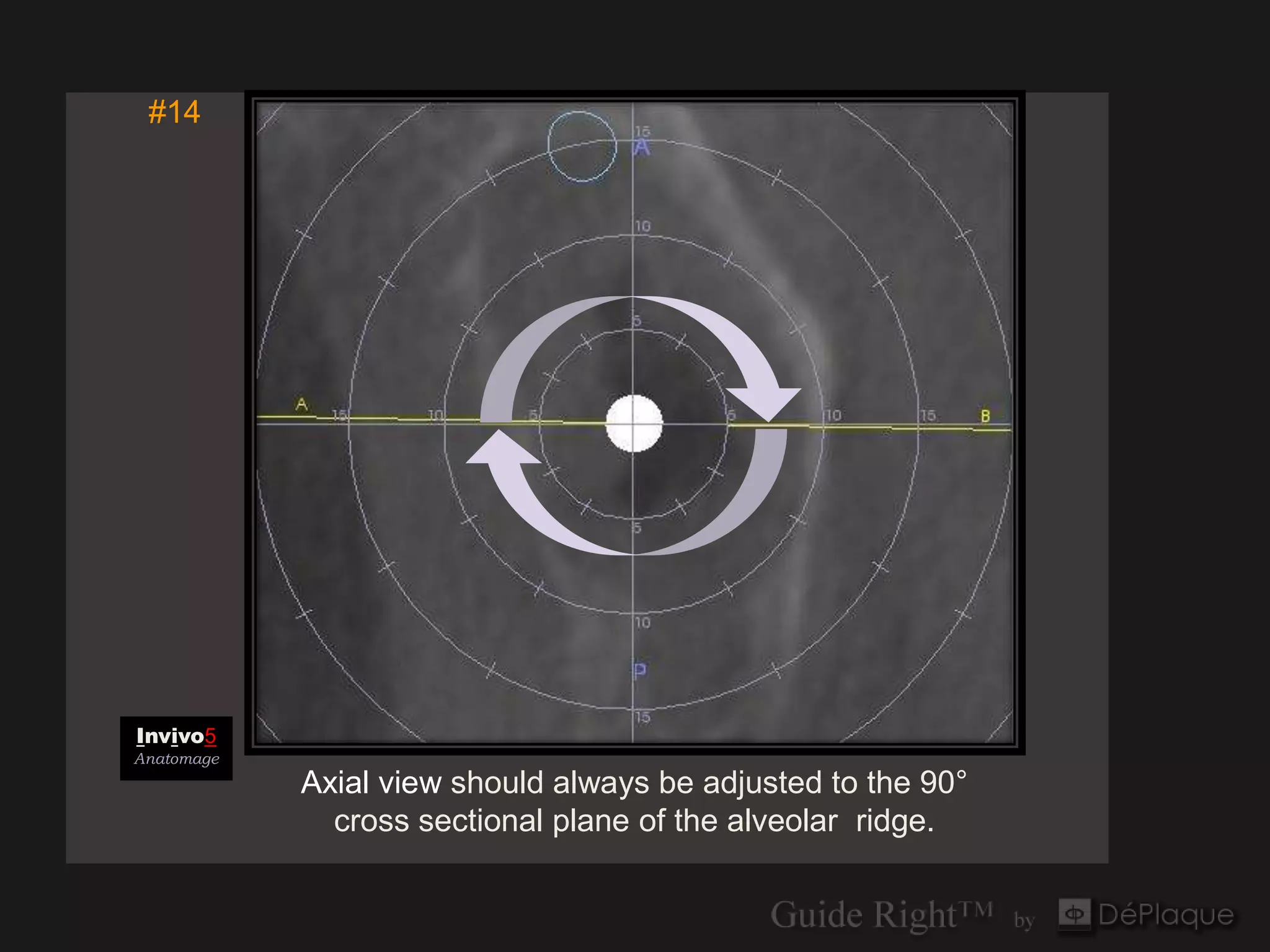 #14




Invivo5
Anatomage
            Axial view should always be adjusted to the 90°
              cross sectional plane of the alveolar ridge.
 