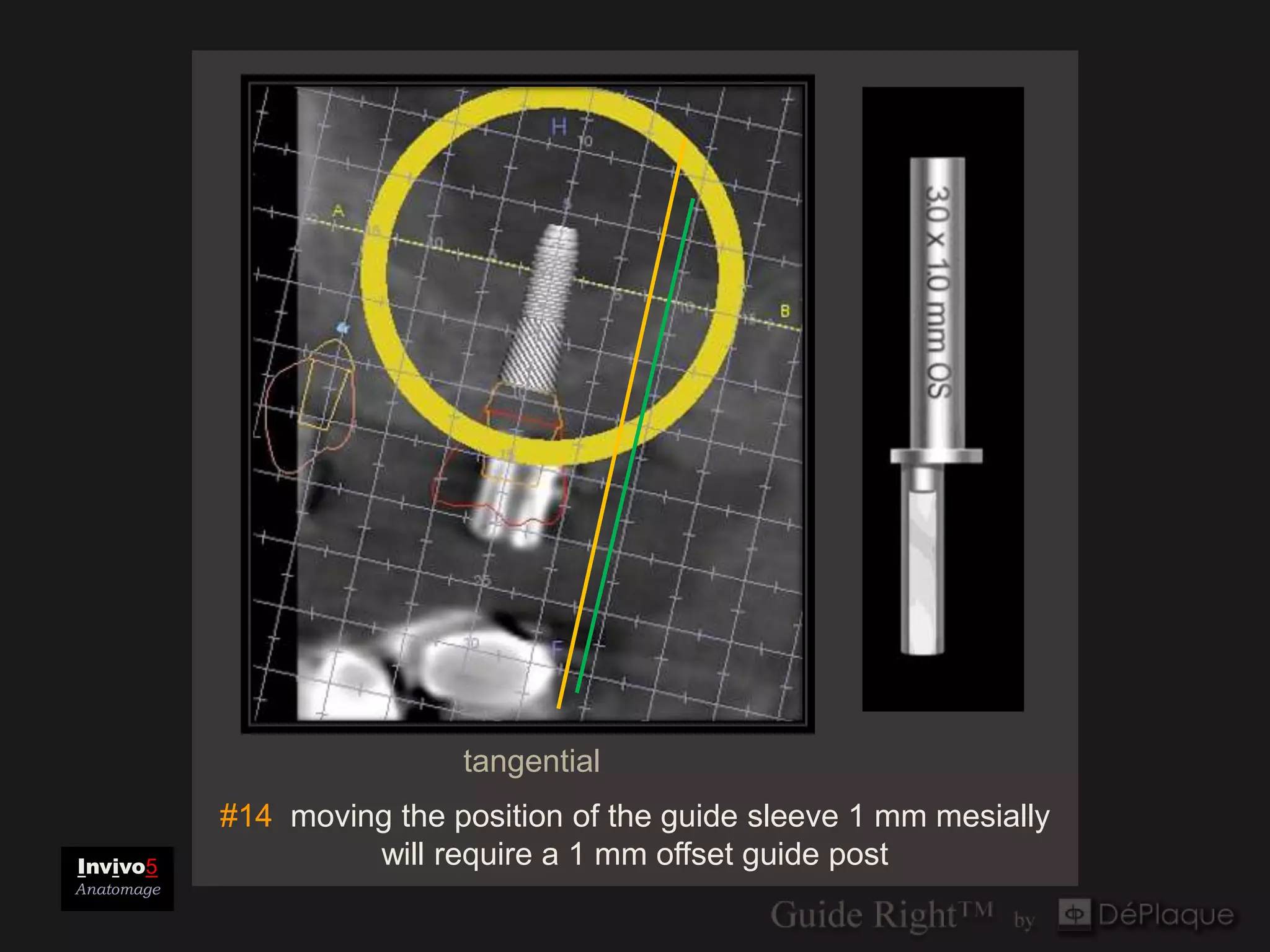 tangential
            #14 moving the position of the guide sleeve 1 mm mesially
Invivo5              will require a 1 mm offset guide post
Anatomage
 