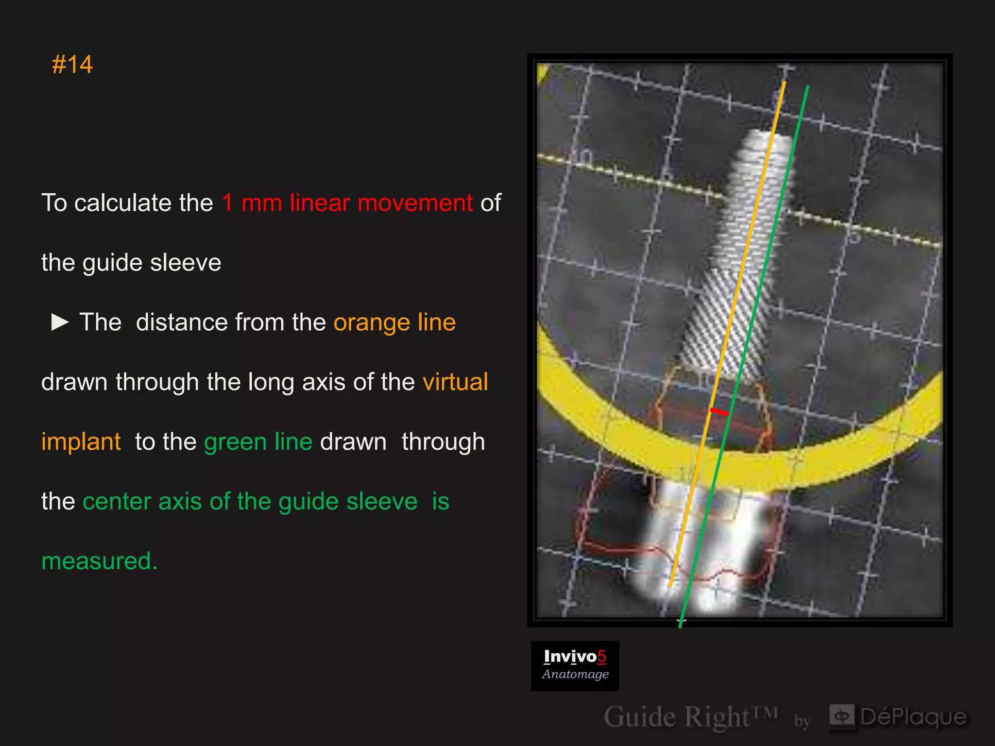 #14




To calculate the 1 mm linear movement of

the guide sleeve

► The distance from the orange line

drawn through the long axis of the virtual

implant to the green line drawn through

the center axis of the guide sleeve is

measured.
                                                         tangential
                                             Invivo5
                                             Anatomage
 