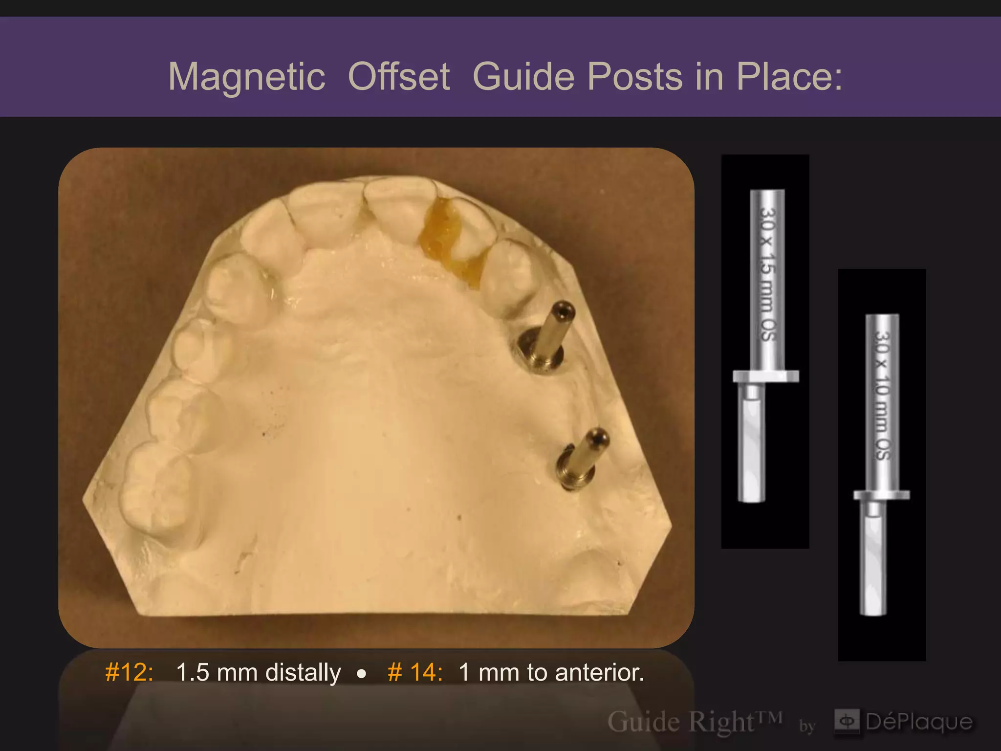 Magnetic Offset Guide Posts in Place:




#12: 1.5 mm distally  # 14: 1 mm to anterior.
 