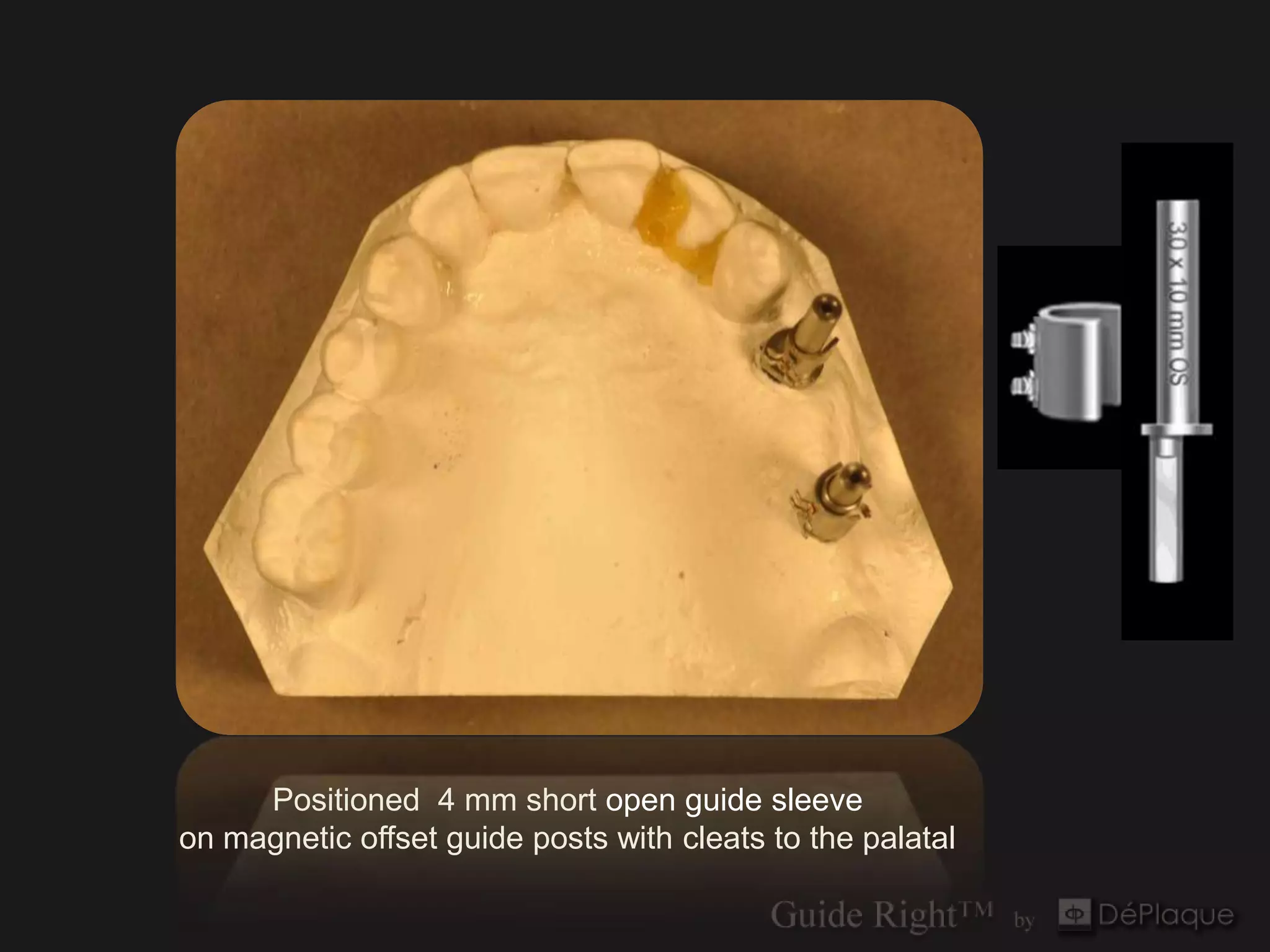 Positioned 4 mm short open guide sleeve
on magnetic offset guide posts with cleats to the palatal
 