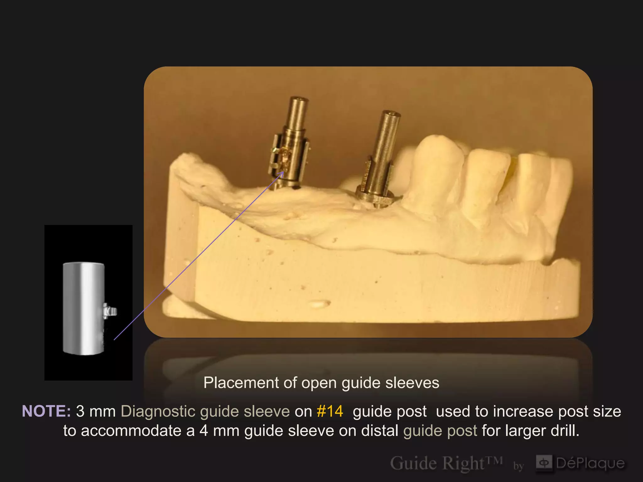 Placement of open guide sleeves
NOTE: 3 mm Diagnostic guide sleeve on #14 guide post used to increase post size
    to accommodate a 4 mm guide sleeve on distal guide post for larger drill.
 
