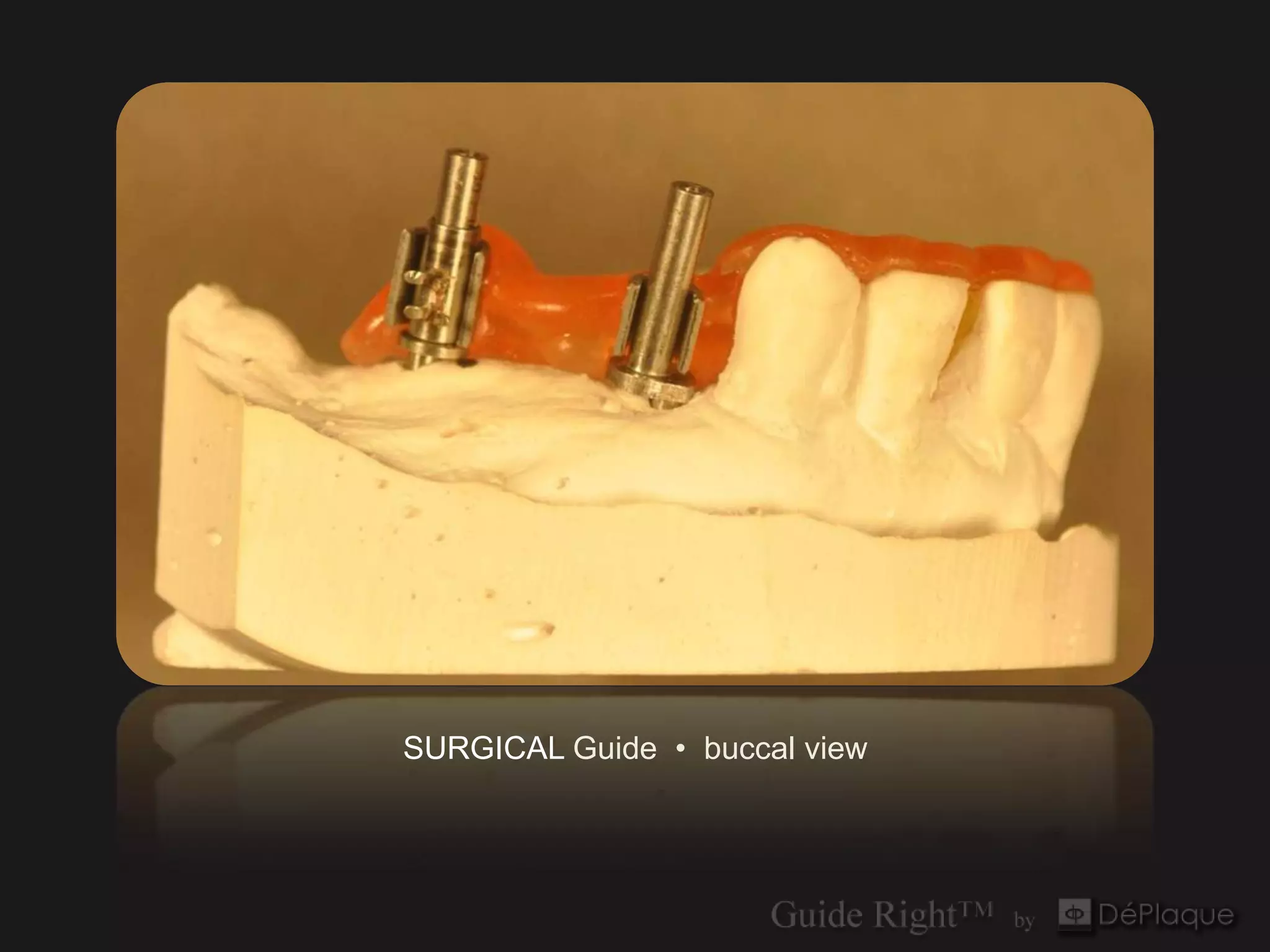SURGICAL Guide • buccal view
 