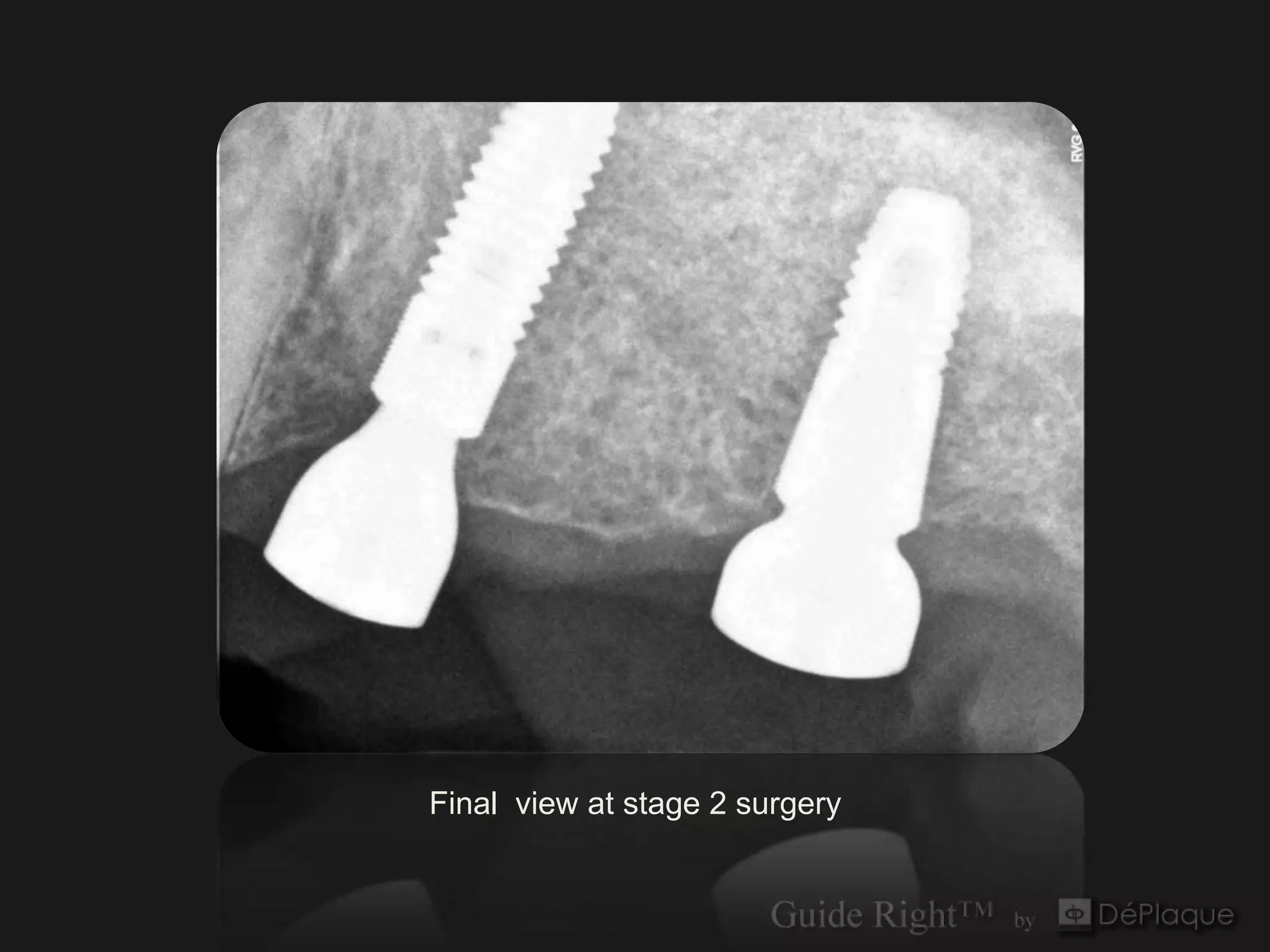 Final view at stage 2 surgery
 