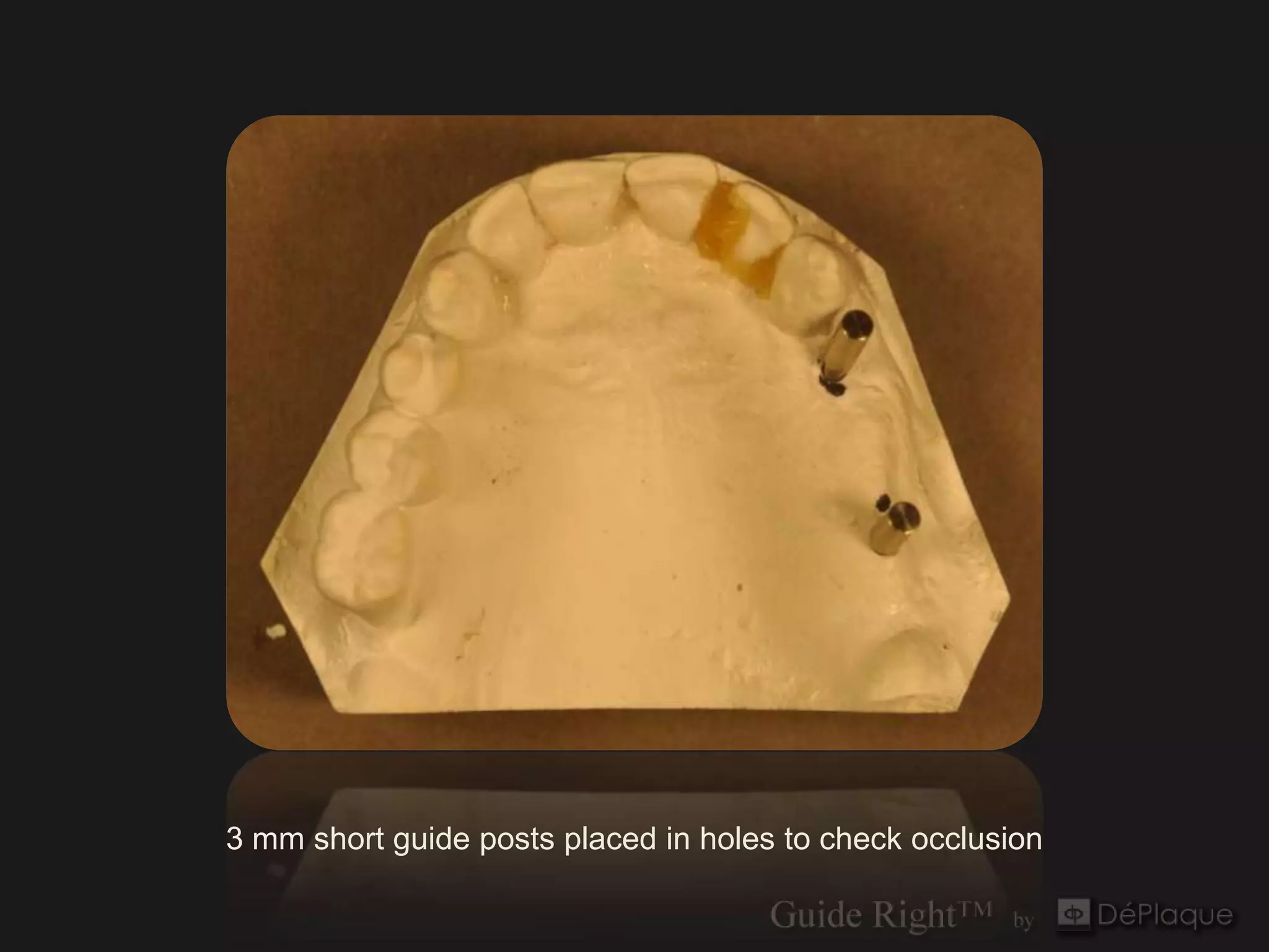 3 mm short guide posts placed in holes to check occlusion
 