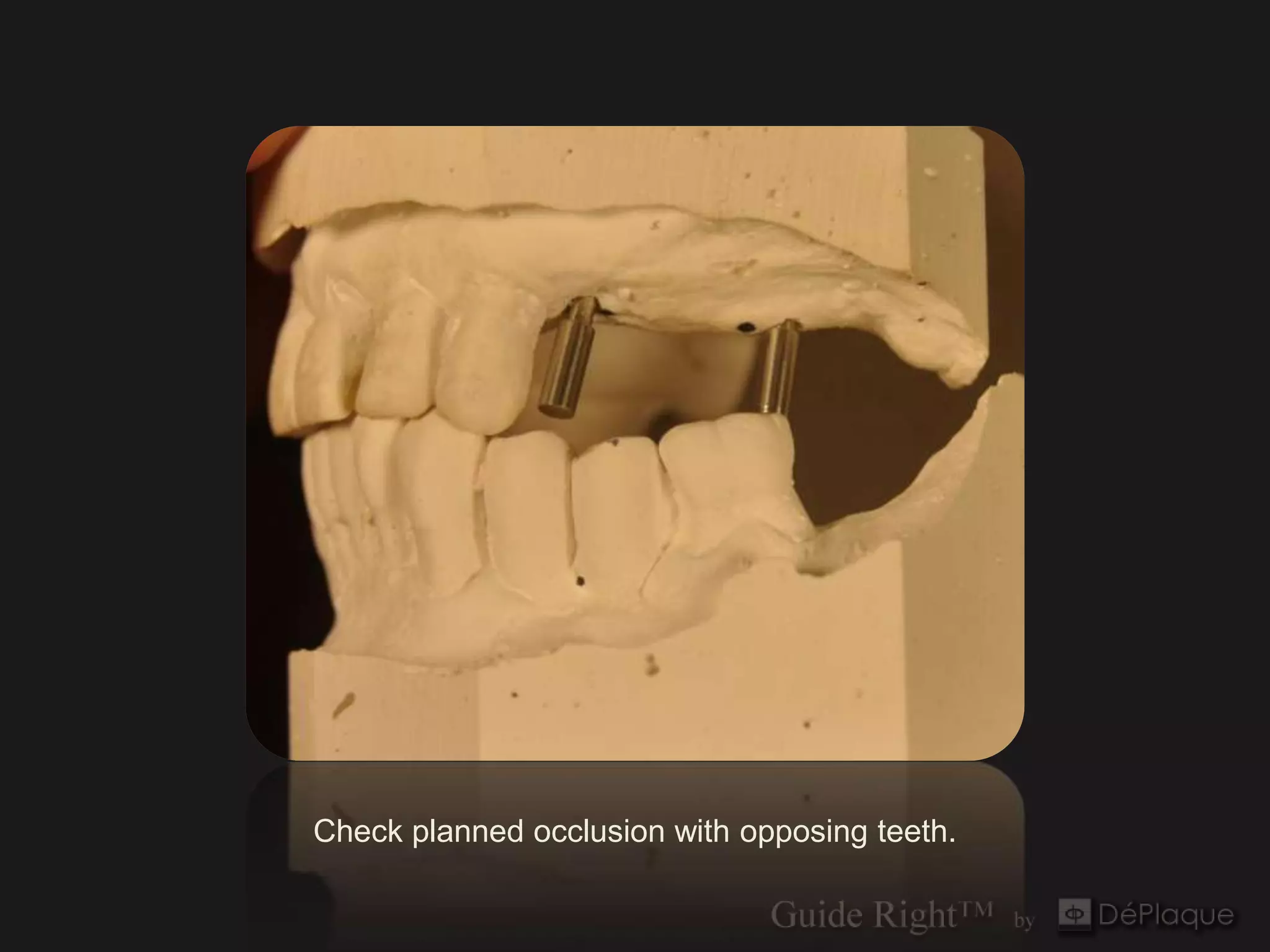 Check planned occlusion with opposing teeth.
 