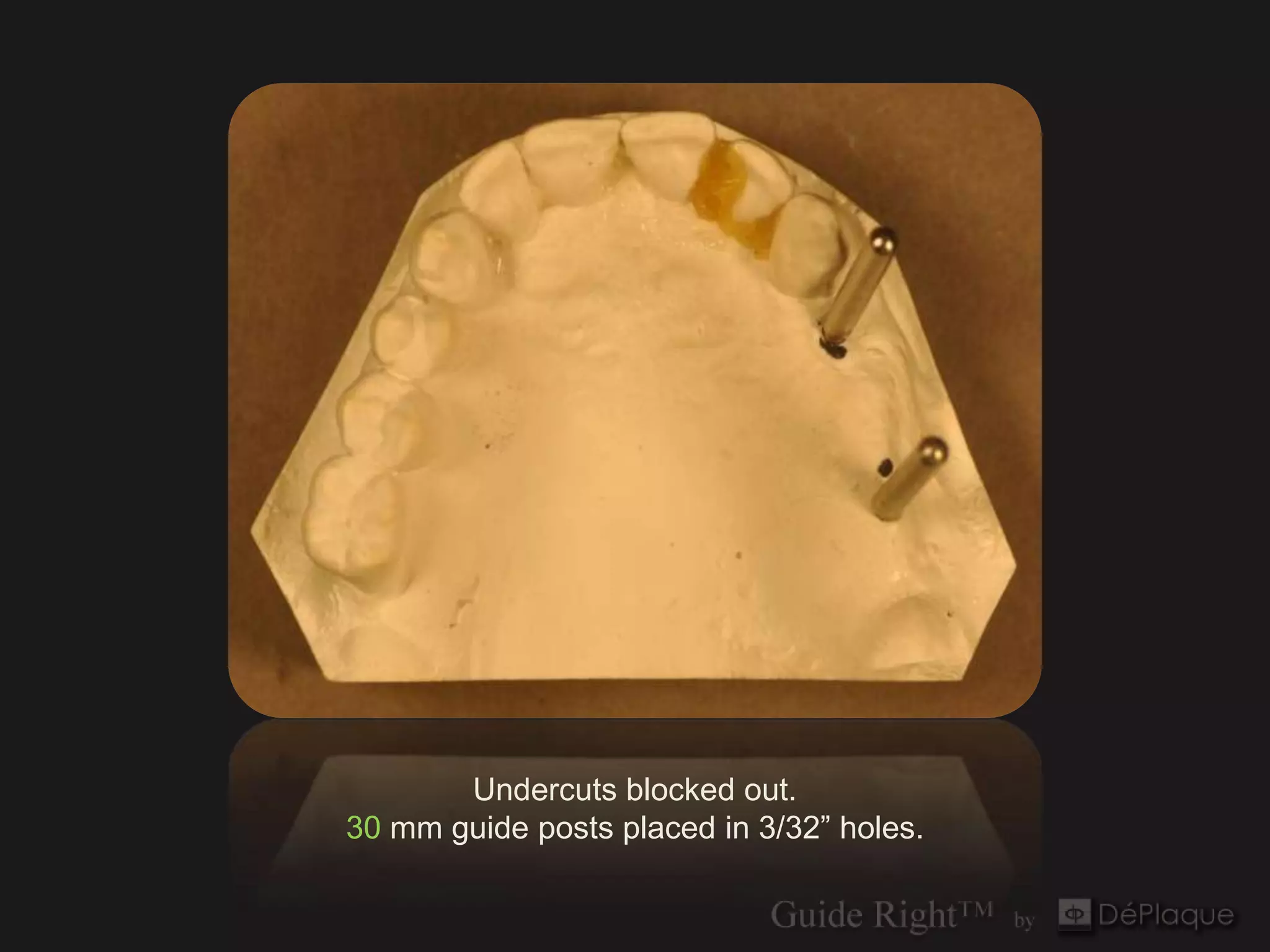 Undercuts blocked out.
30 mm guide posts placed in 3/32” holes.
 