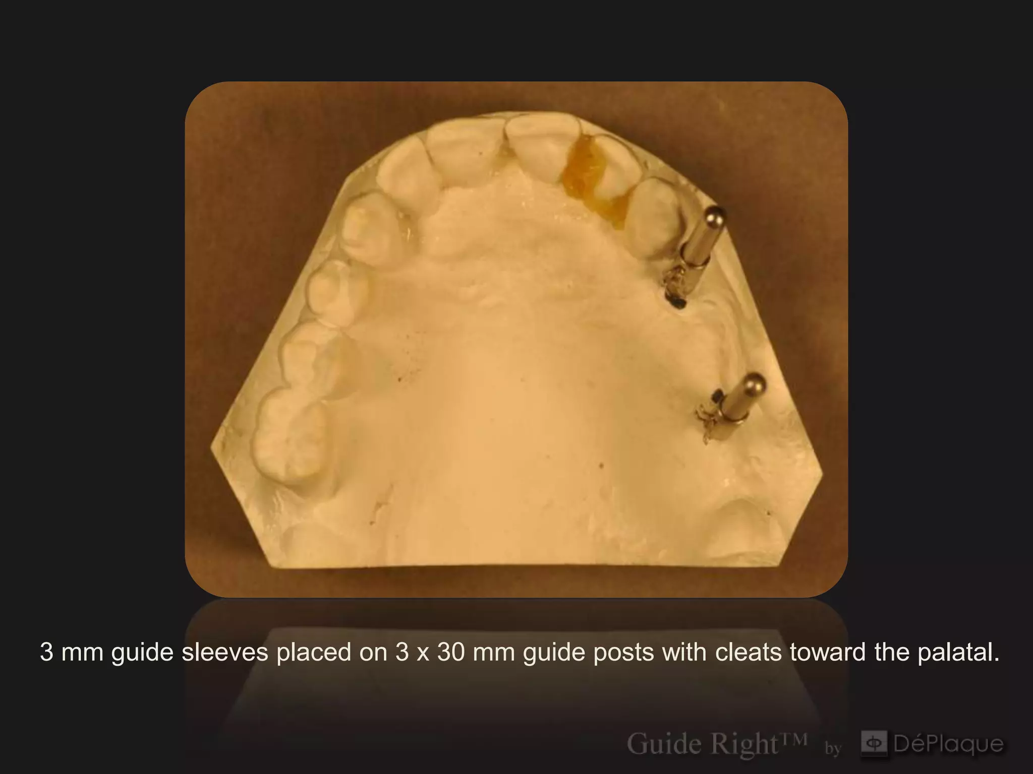 3 mm guide sleeves placed on 3 x 30 mm guide posts with cleats toward the palatal.
 