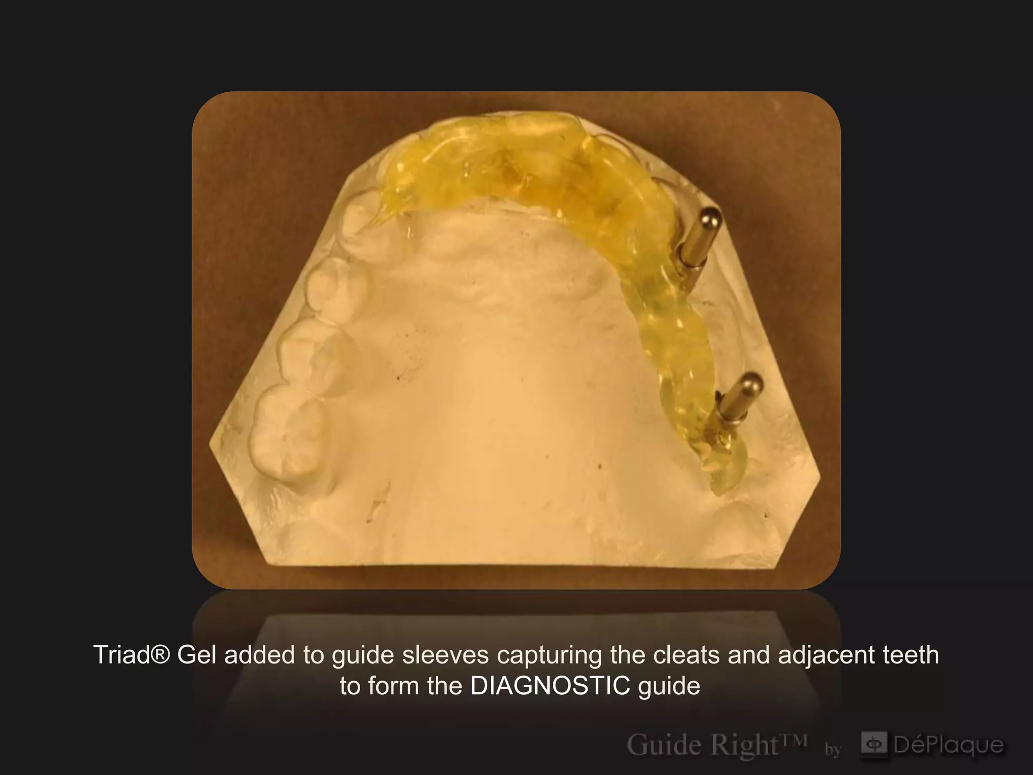 Triad® Gel added to guide sleeves capturing the cleats and adjacent teeth
                     to form the DIAGNOSTIC guide
 
