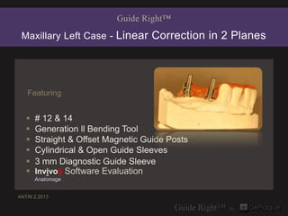 Guide Right™

 Maxillary Left Case - Linear Correction in 2 Planes




   Featuring


      # 12 & 14
      Generation ll Bending Tool
      Straight & Offset Magnetic Guide Posts
      Cylindrical & Open Guide Sleeves
      3 mm Diagnostic Guide Sleeve
      Invivo5 Software Evaluation
       Anatomage


ANTIN 2.2013
 