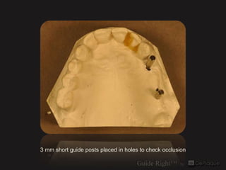 3 mm short guide posts placed in holes to check occlusion
 
