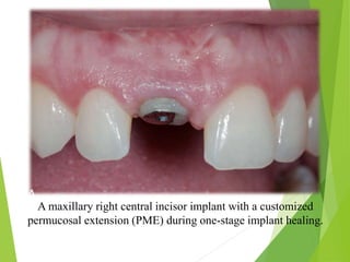 A maxillary right central incisor implant with a customized
permucosal extension (PME) during one-stage implant healing.
 