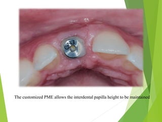 The customized PME allows the interdental papilla height to be maintained
 