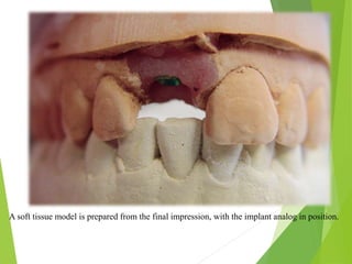 A soft tissue model is prepared from the final impression, with the implant analog in position.
 
