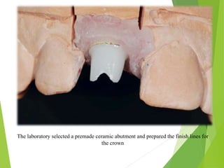The laboratory selected a premade ceramic abutment and prepared the finish lines for
the crown
 
