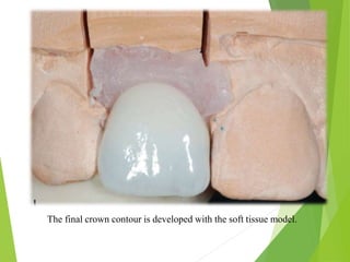 The final crown contour is developed with the soft tissue model.
 