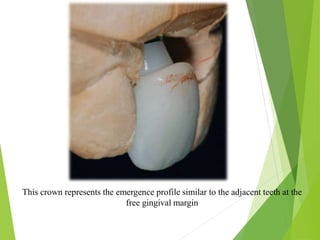 This crown represents the emergence profile similar to the adjacent teeth at the
free gingival margin
 