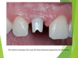 The indirect technique first seats the final abutment prepared by the laboratory.
 